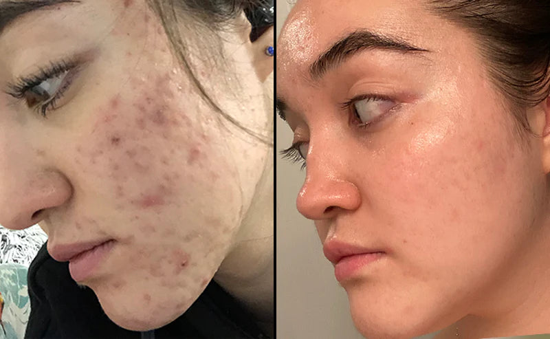 My Microbiome journey.